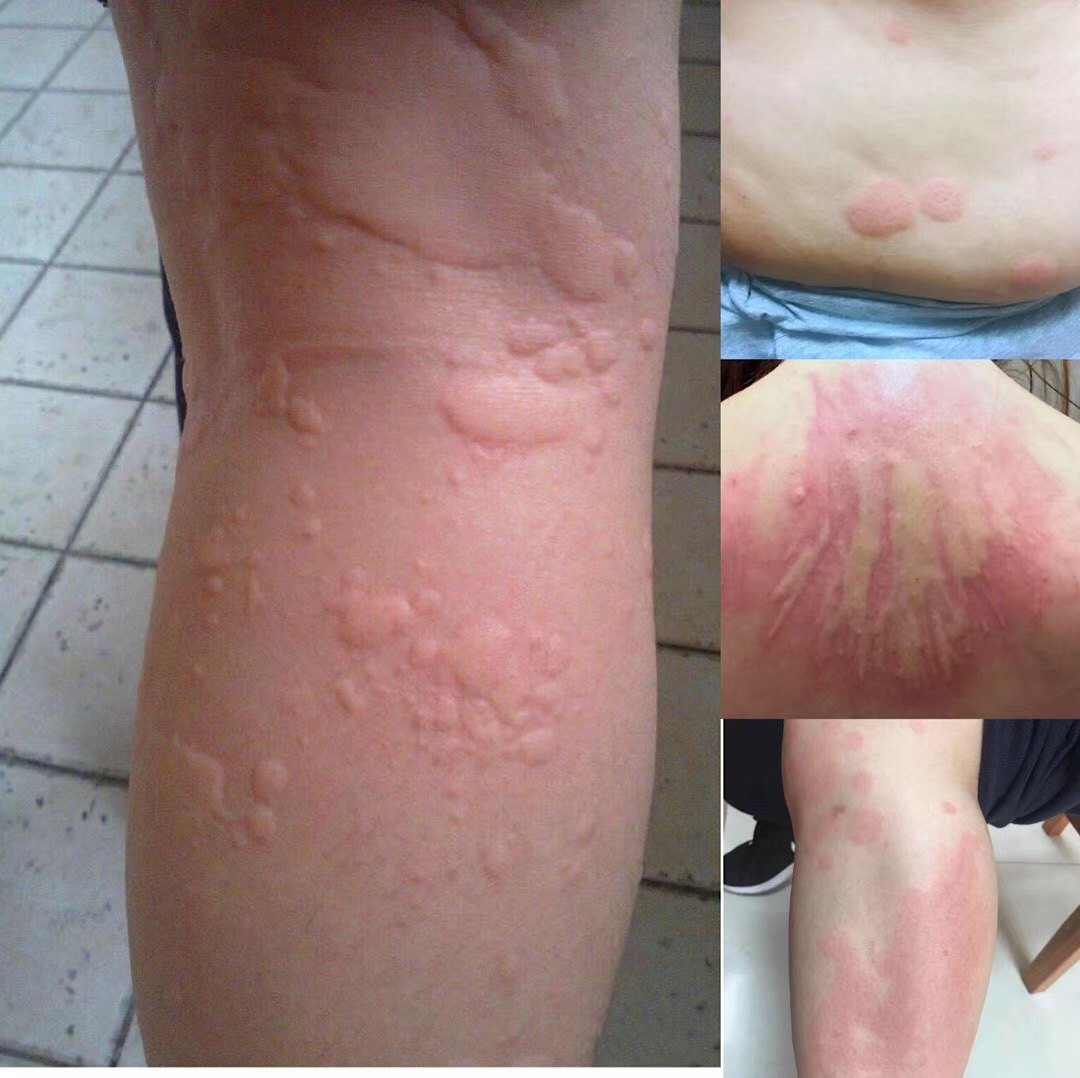 发生荨麻疹时,皮肤上起风团,红斑,伴有剧烈瘙痒,也可以有腹痛,腹泻